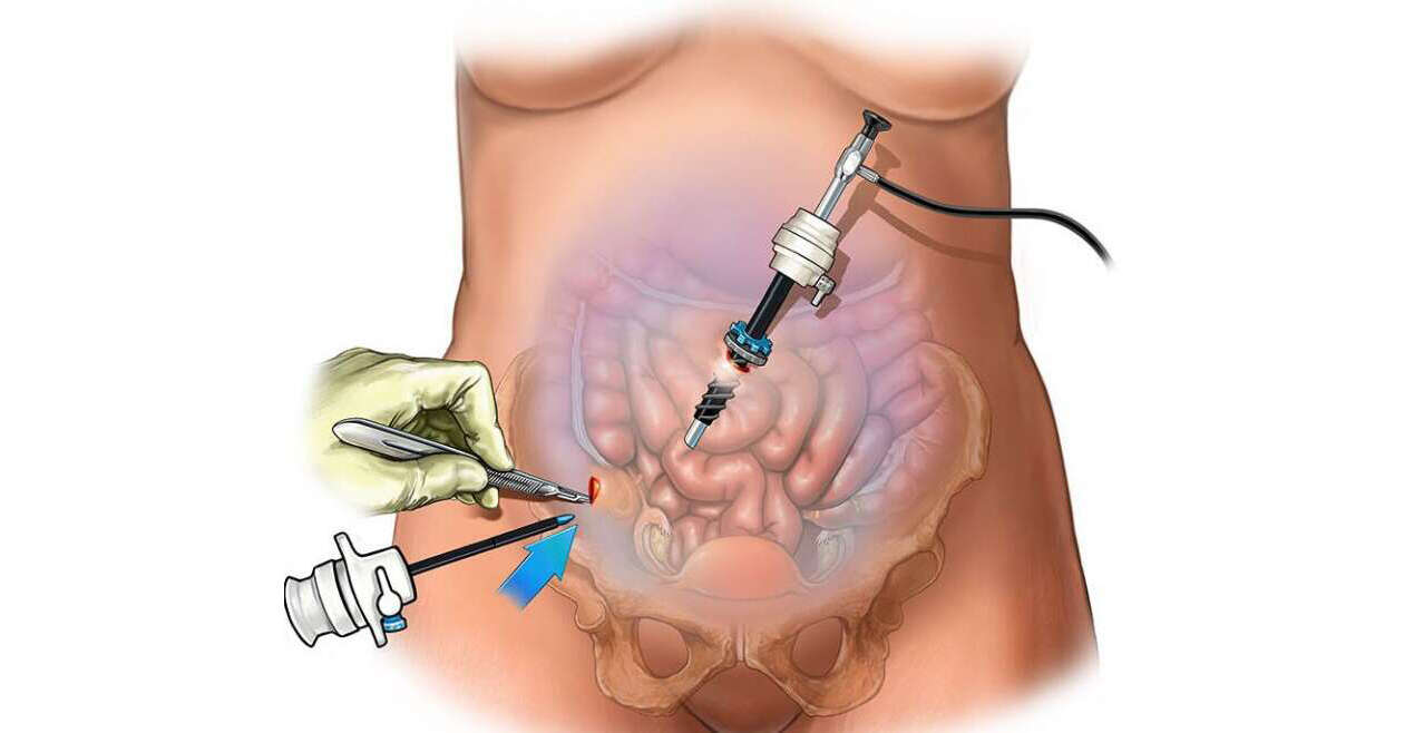 Laparoscopy