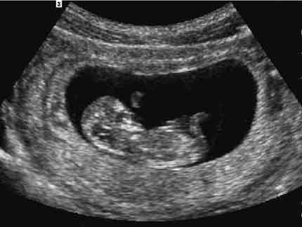 Ultrasound in Obstretrics